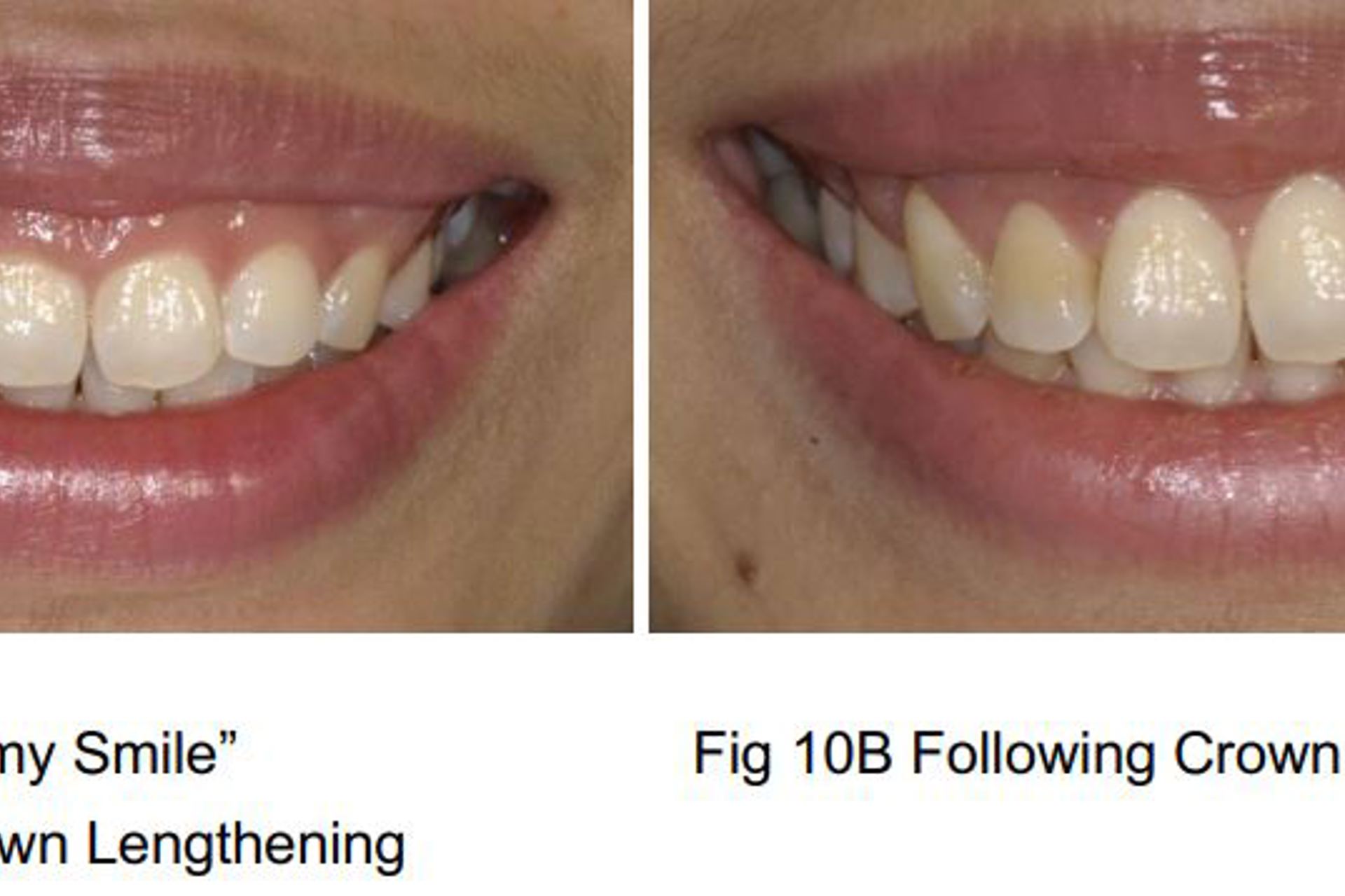 Figures 10A B Gummy Smile