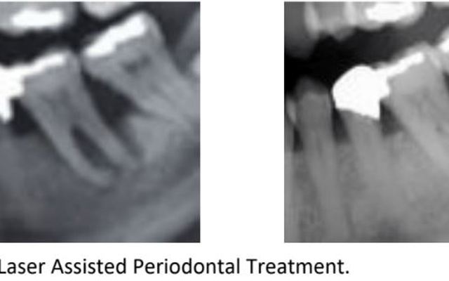 Figure 11B Regeneration On Teeth