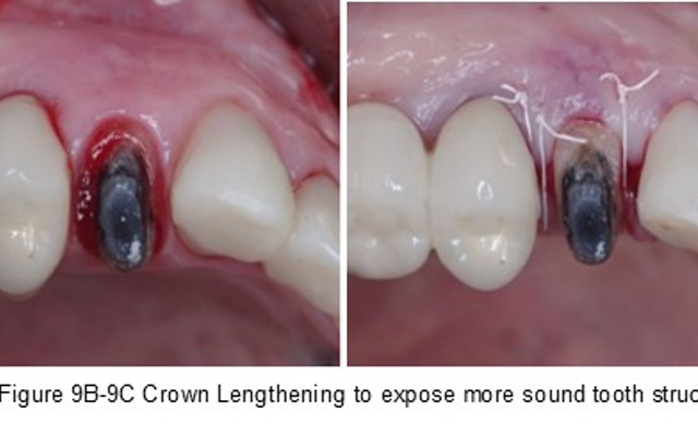 Figure 9B 9C Crown Lenthening