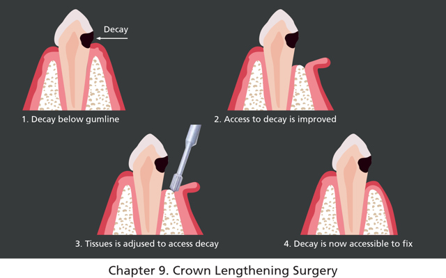 Figure 9A Crown Lengthening