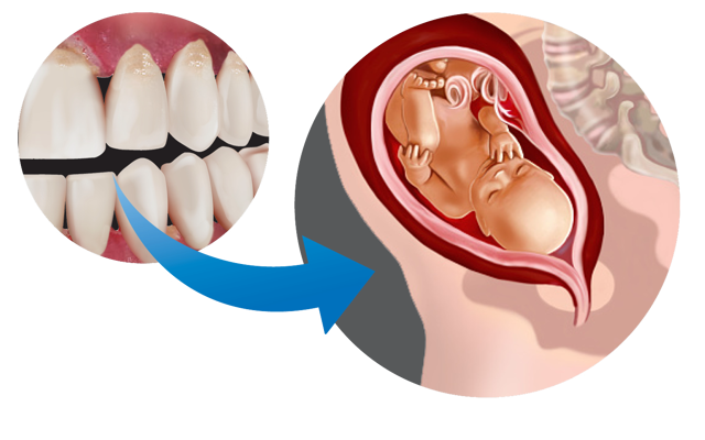 Figure 6D Gum Disease And Pregnancy